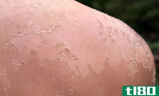 A person's shoulder peeling from a sunburn.