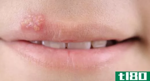 Lip balm used to treat chapped lips from a cold sore should not be resused.