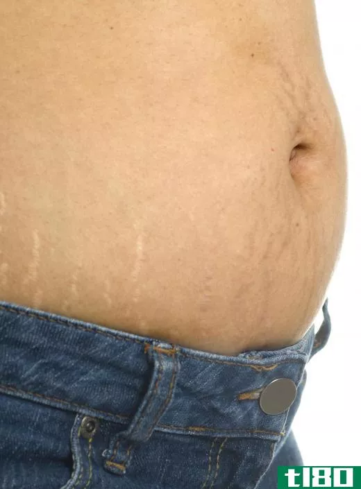 Parafango may be used to reduce the appearance of stretch marks.