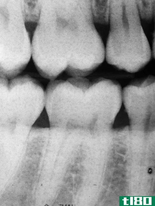 Dental X-ray.
