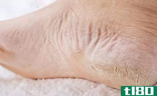 People with cracked heels may benefit from lanolin.