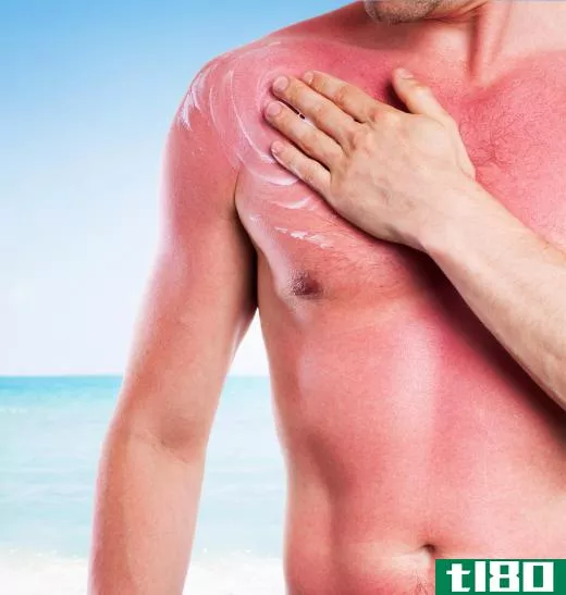 People with Fitzpatrick skin types I-II often sunburn easily.