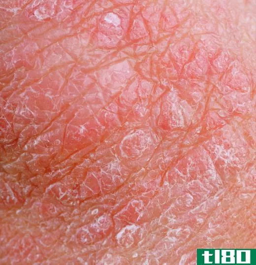 Skin zinc can reduce irritation from eczema.