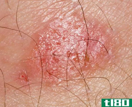 Ringworm is a fungal infection that may be treated with skin zinc.