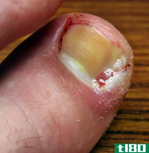 Medicure can involve the simple diagnosis and treatment of foot problems like an ingrown toenail.