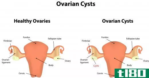 Squalane has been found in ovarian cysts.