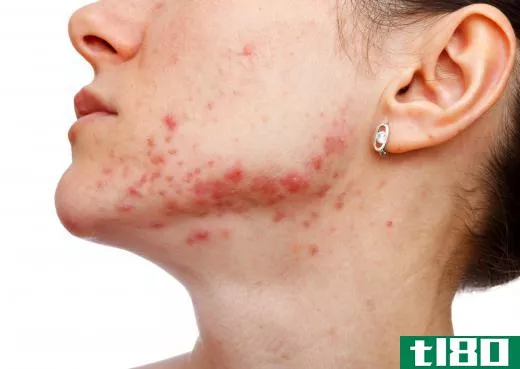 Salicylic acid is a phenol that is used to treat acne.