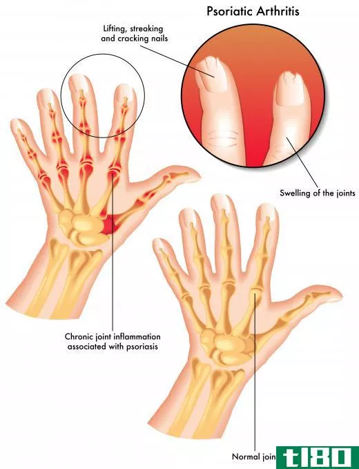 Psoriatic arthritis is often accompanied by psoriatic nail disease.