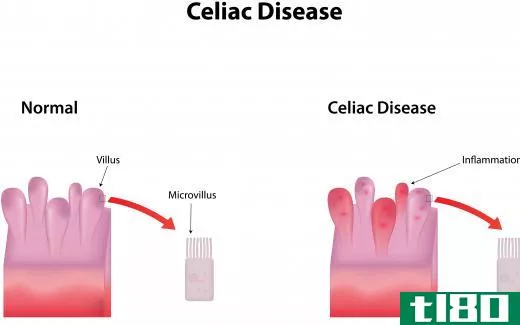 The diet for someone with celiac disease may be useful for someone with psoriasis.