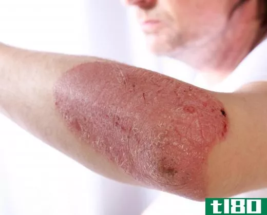Some patients may find their psoriasis is triggered by certain foods or drinks.