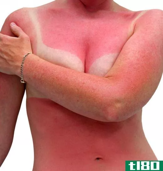 Ultimately, preventative measures and avoiding burning in the first place are the best ways to treat a sunburn.
