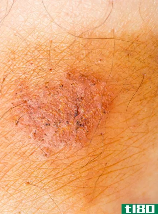 The earliest sign of Lyme disease is the characteristic Lyme disease rash, which appears between three and 30 days following infection.