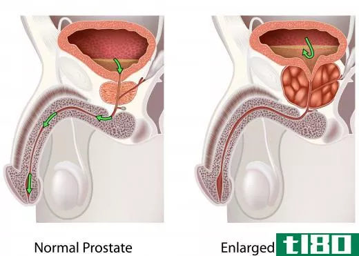 Men with an enlarged prostate can be more prone to cystitis because of how it interferes with with urination.