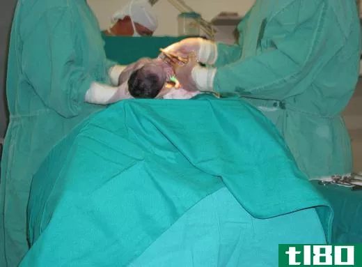 Babies delivered by cesarean section tend to have rounder, more regularly-shaped heads.