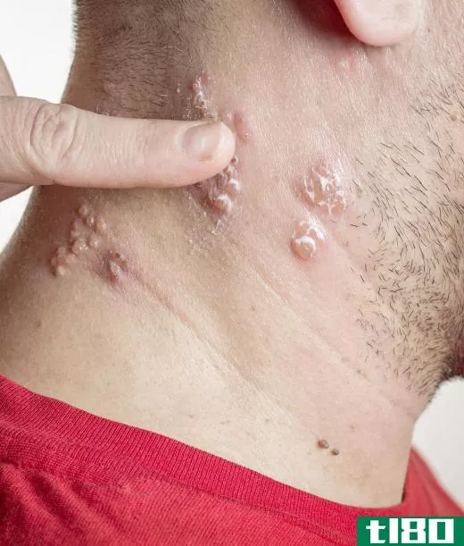 Ramsay Hunt syndrome comes from the same virus that causes shingles.