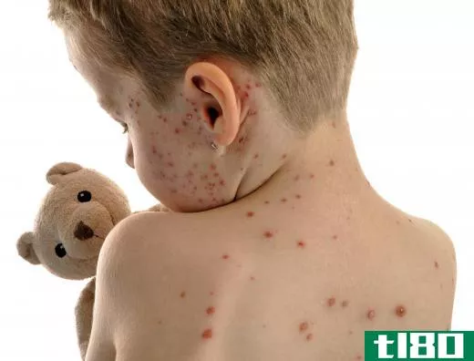 A boy with chickenpox.