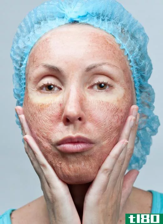 Dry or peeling skin is a common side effect of too much retinol.