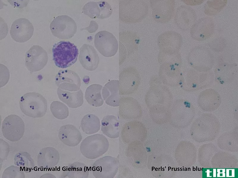 嗜碱性点彩(basophilic stippling)和帕彭海默尸体(pappenheimer bodies)的区别