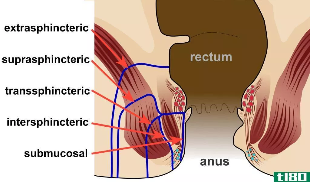 吻合(anastomosis)和瘘管(fistula)的区别
