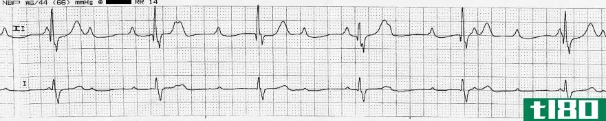 第一和第二(1st 2nd)和三度心脏传导阻滞(3rd degree heart block)的区别