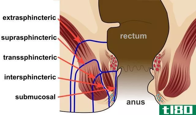 痔疮(piles)和瘘管(fistula)的区别