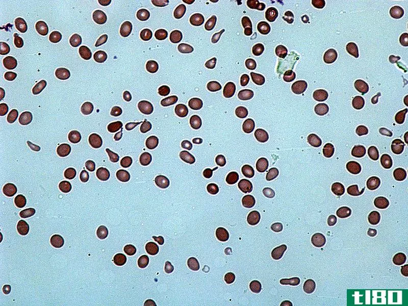 不等红细胞(anisocytosis)和粒细胞增多症(poikilocytosis)的区别