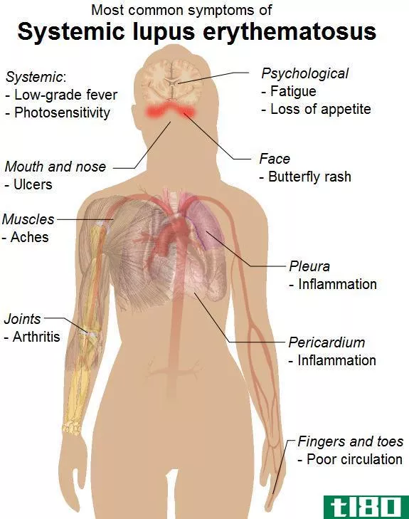 狼疮(lupus)和纤维肌痛(fibromyalgia)的区别
