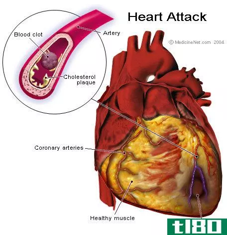 缺血(ischemia)和梗塞(infarction)的区别