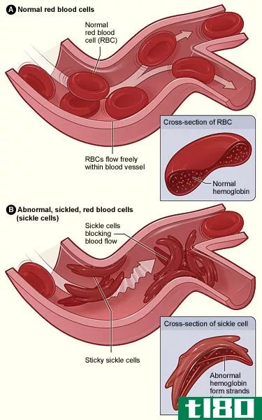 镰状细胞病(sickle cell disease)和镰状细胞性贫血(sickle cell anemia)的区别