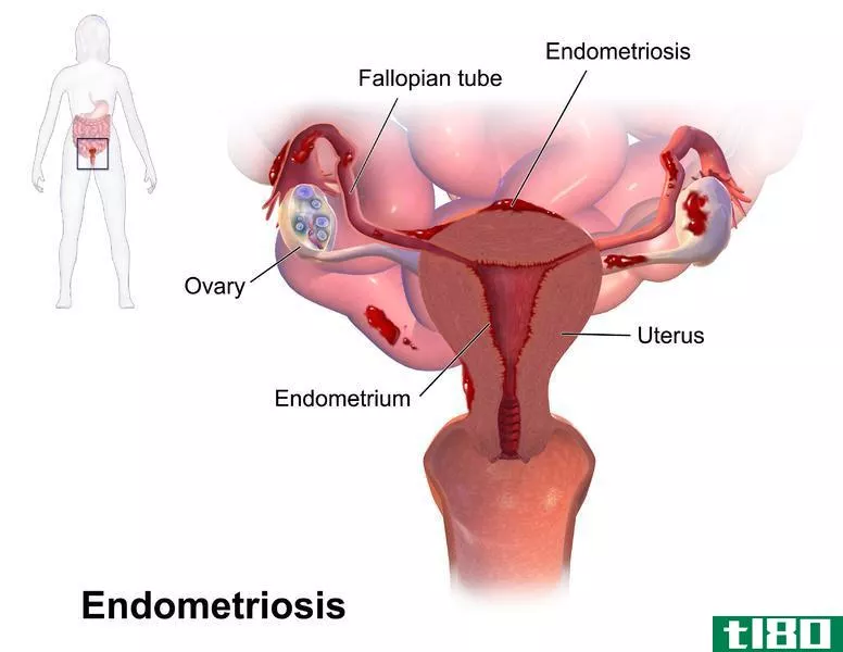 ******症(endometriosis)和*****(endometrial cancer)的区别