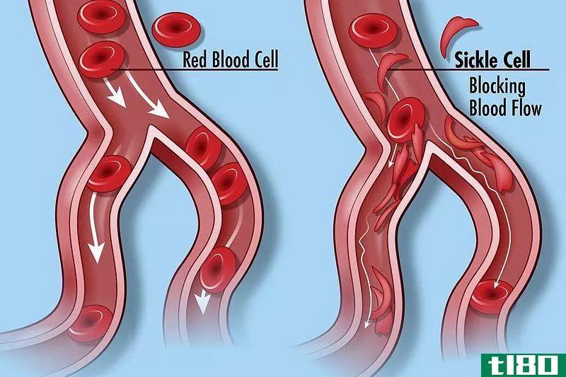 正常红细胞(normal red blood cell)和镰状细胞(sickle cell)的区别