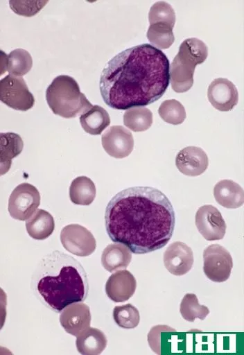 成髓细胞(myeloblast)和淋巴母细胞(lymphoblast)的区别