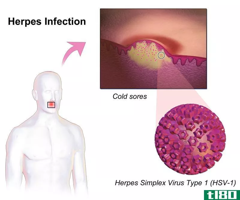 木瓦(shingles)和疱疹(herpes)的区别