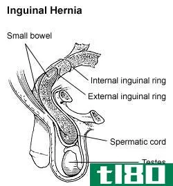疝(hernia)和痔疮(hemorrhoid)的区别