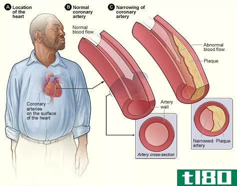 冠状动脉疾病(coronary artery disease)和动脉粥样硬化(atherosclerosis)的区别