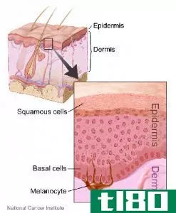 皮肤癌(skin cancer)和黑色素瘤(melanoma)的区别