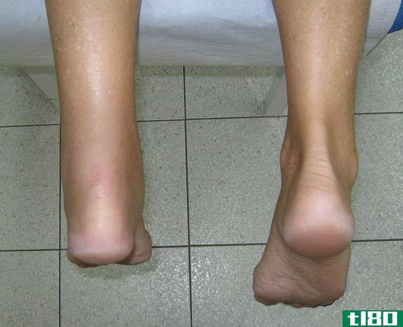 腱鞘炎(tenosynovitis)和肌腱炎(tendonitis)的区别