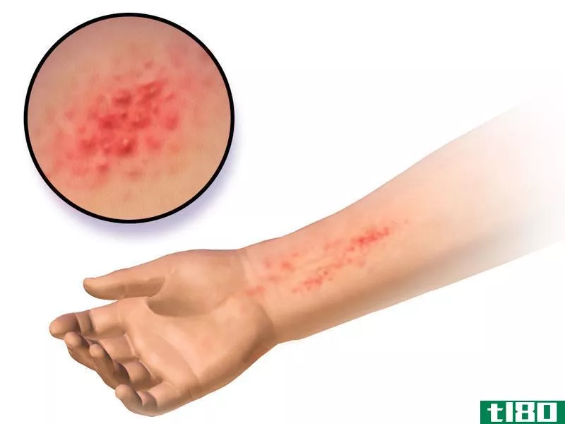特应性皮炎(atopic dermatitis)和接触性皮炎(contact dermatitis)的区别