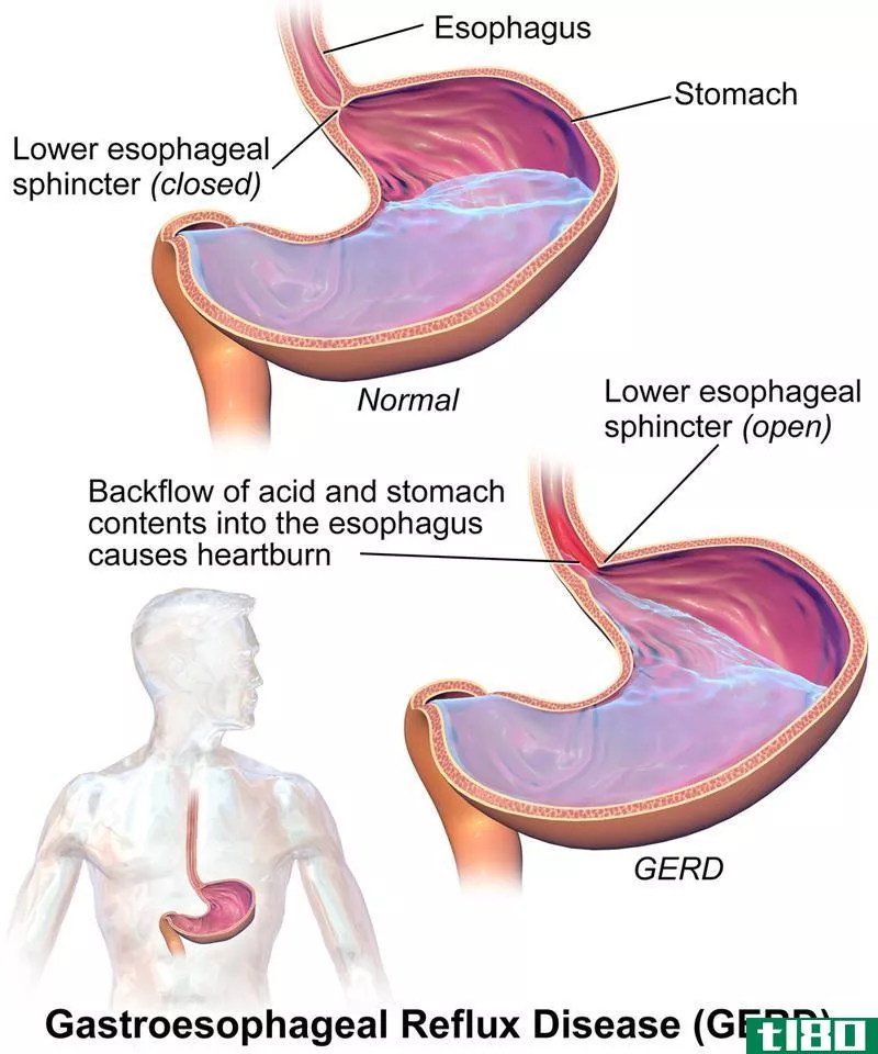 格尔德(gerd)和酸回流(acid reflux)的区别