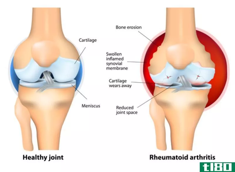 关节炎(arthritis)和腕管综合征(carpal tunnel syndrome)的区别