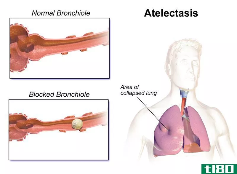 肺不张(atelectasis)和气胸(pneumothorax)的区别