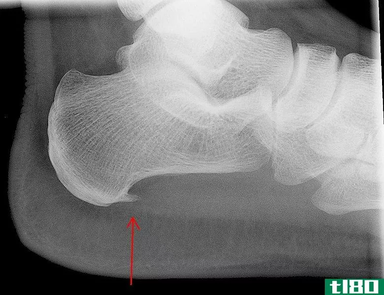 跟骨刺(heel spurs)和足底筋膜炎(plantar fasciitis)的区别