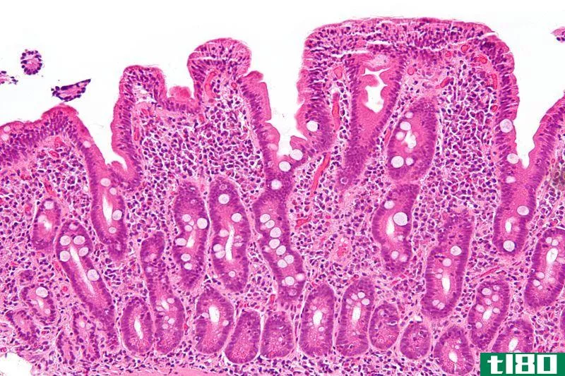乳糜泻(celiac)和克罗恩病(crohn’s disease)的区别