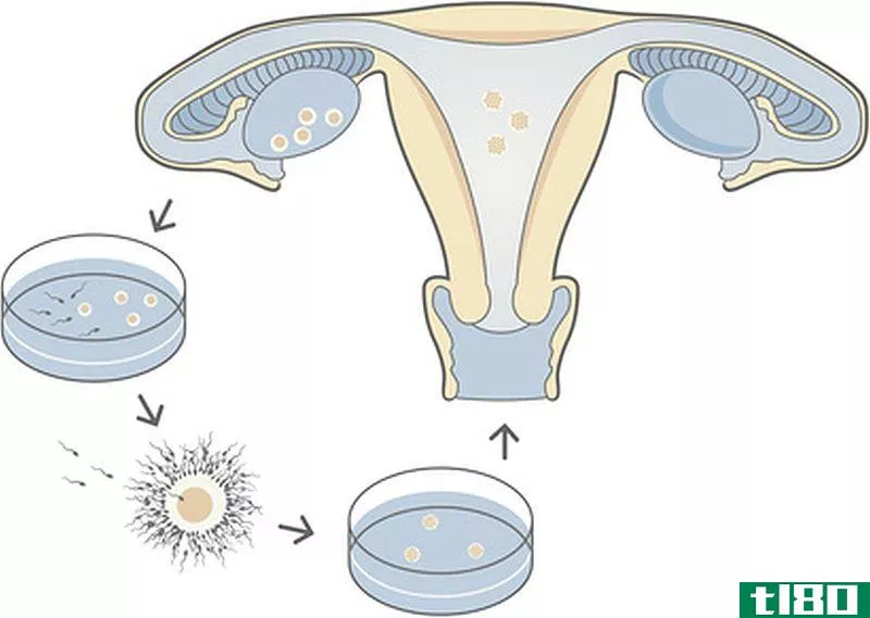 试管受精(ivf)和代孕(surrogacy)的区别