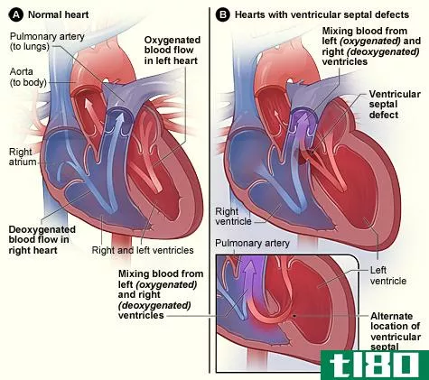 发绀(cyanotic)和非血管性先天性心脏病(acyanotic congenital heart defects)的区别