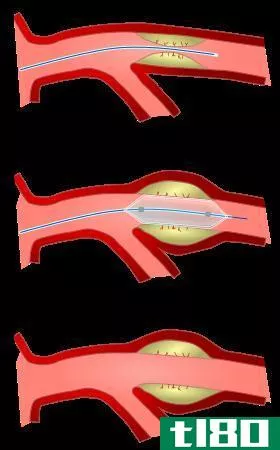 血管成形术(angioplasty)和支架(stent)的区别