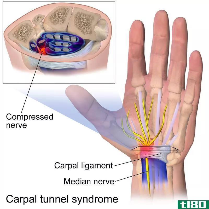 关节炎(arthritis)和腕管综合征(carpal tunnel syndrome)的区别