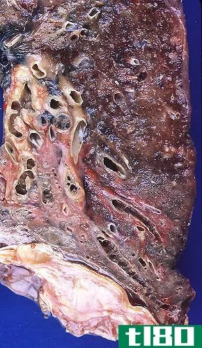 间质性肺病(interstitial lung disease)和支气管扩张(bronchiectasis)的区别