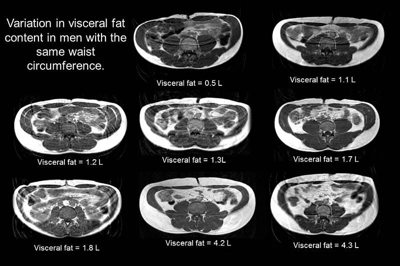 内脏脂肪(visceral fat)和皮下脂肪(subcutaneous fat)的区别