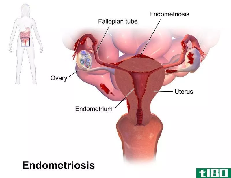 多氯联苯(pcos)和******症(endometriosis)的区别